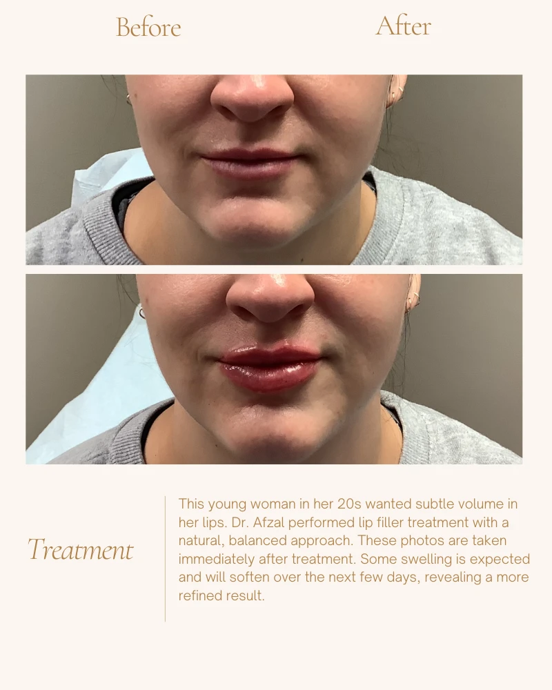 fillers-1