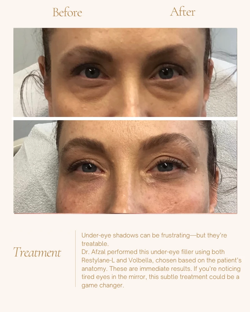 fillers-10
