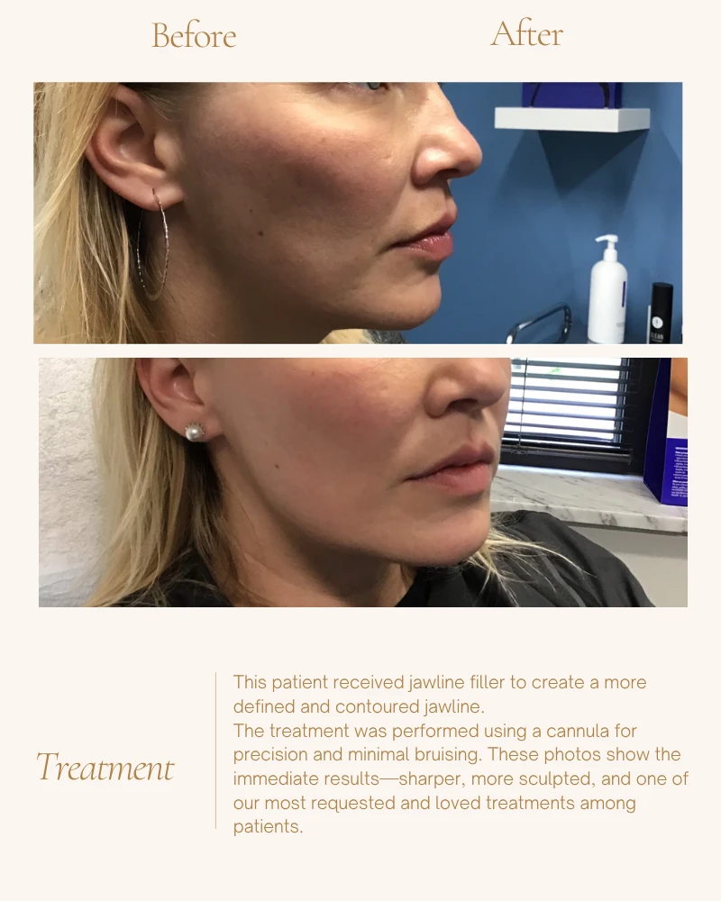 fillers-12