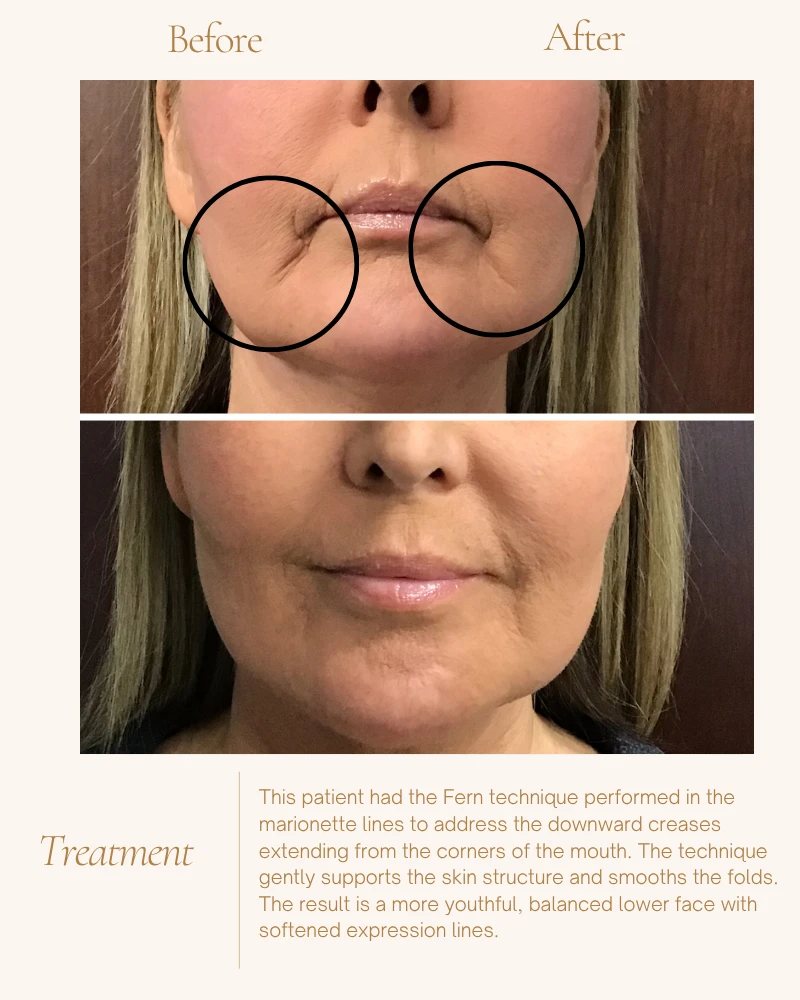 fillers-14