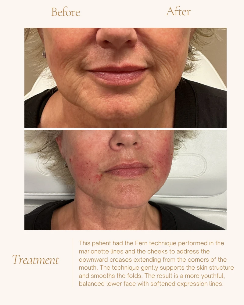 fillers-15