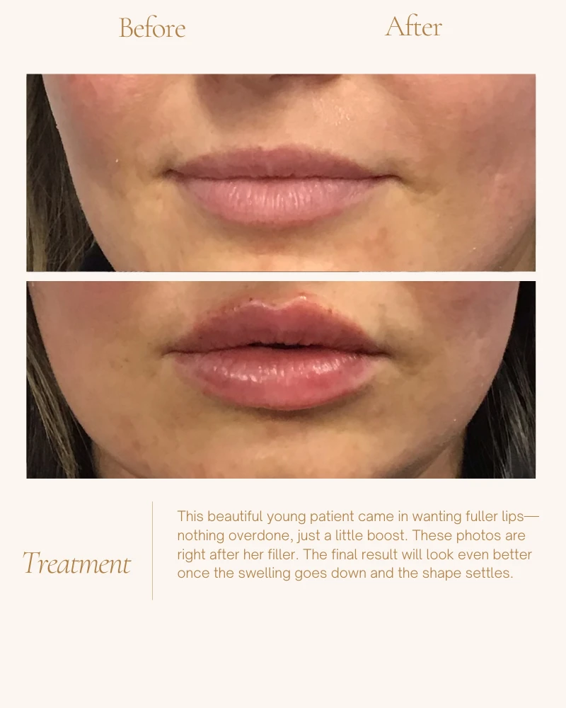 fillers-2