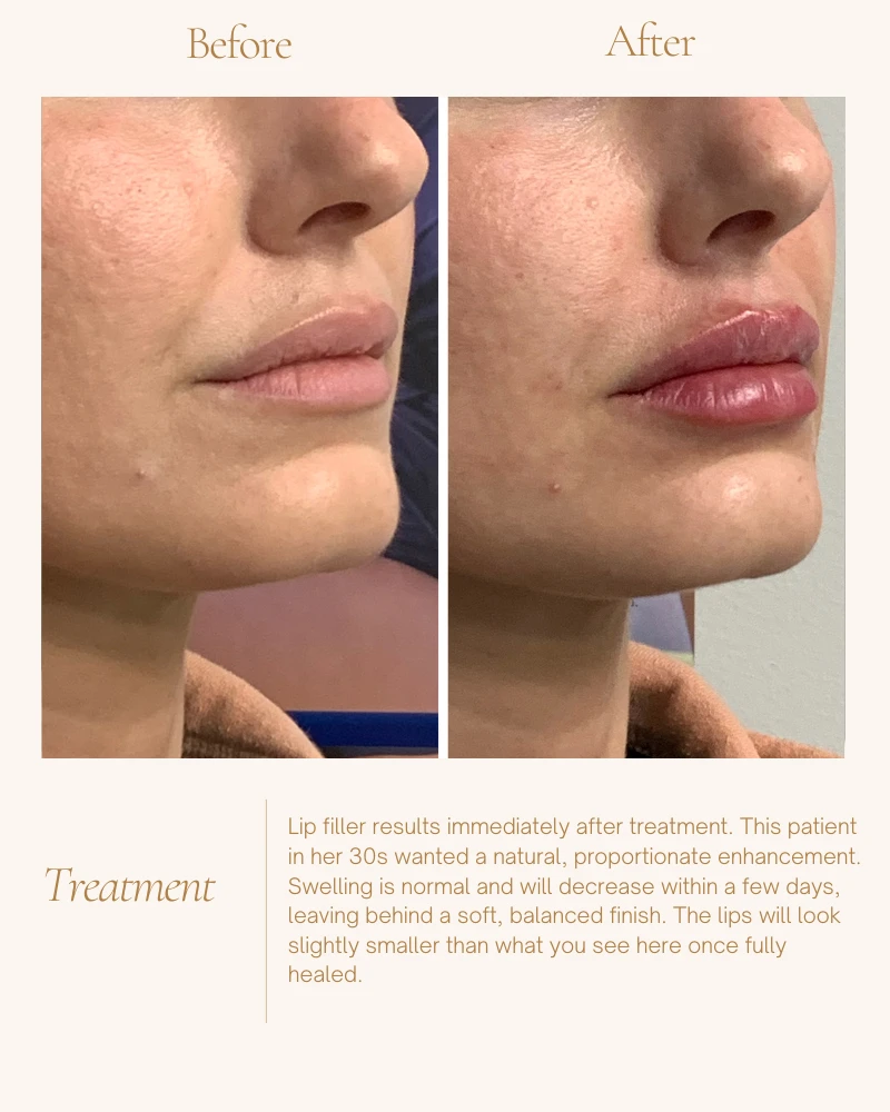 fillers-3
