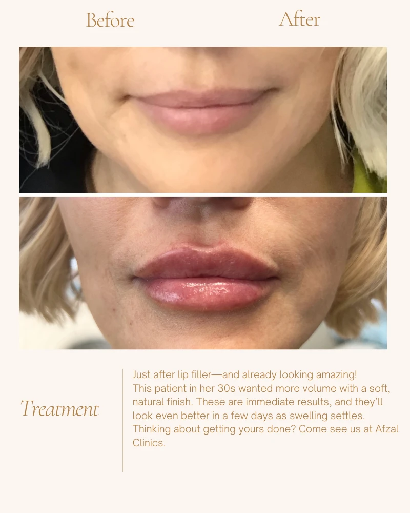 fillers-4