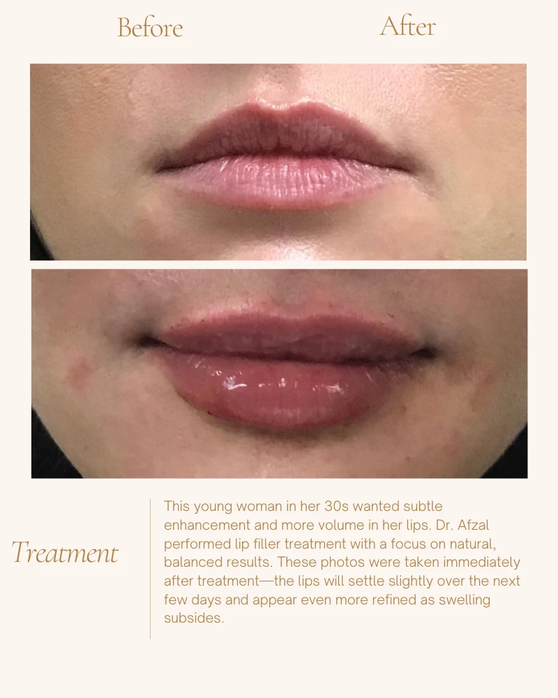 fillers-5