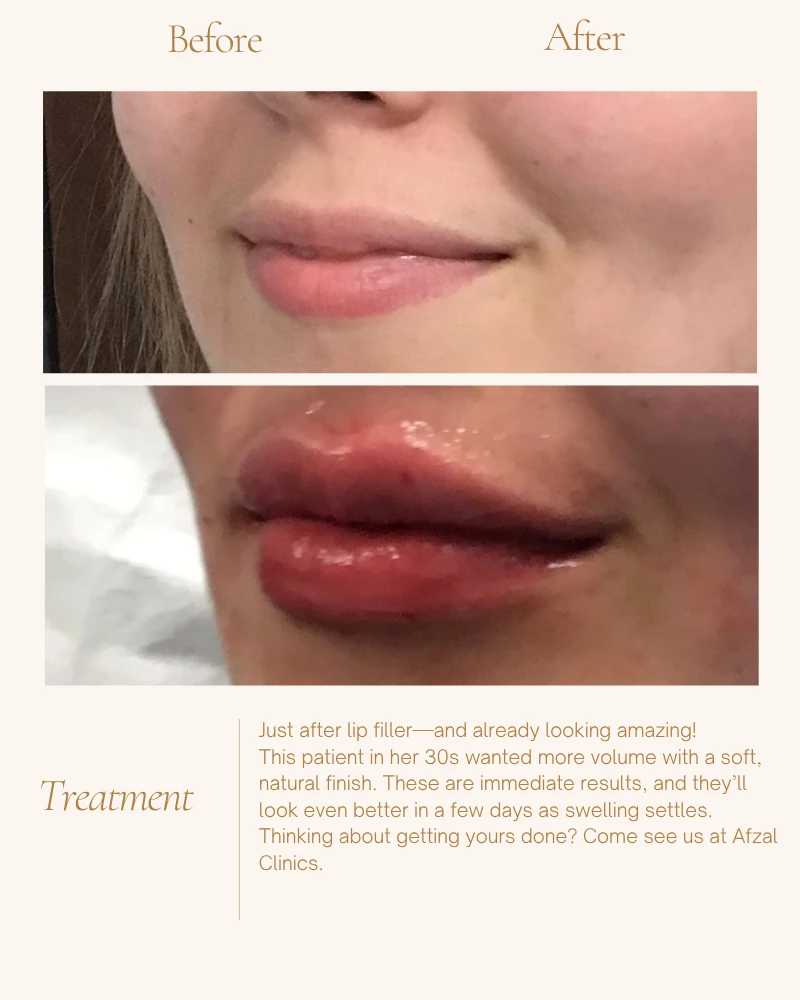 fillers-6