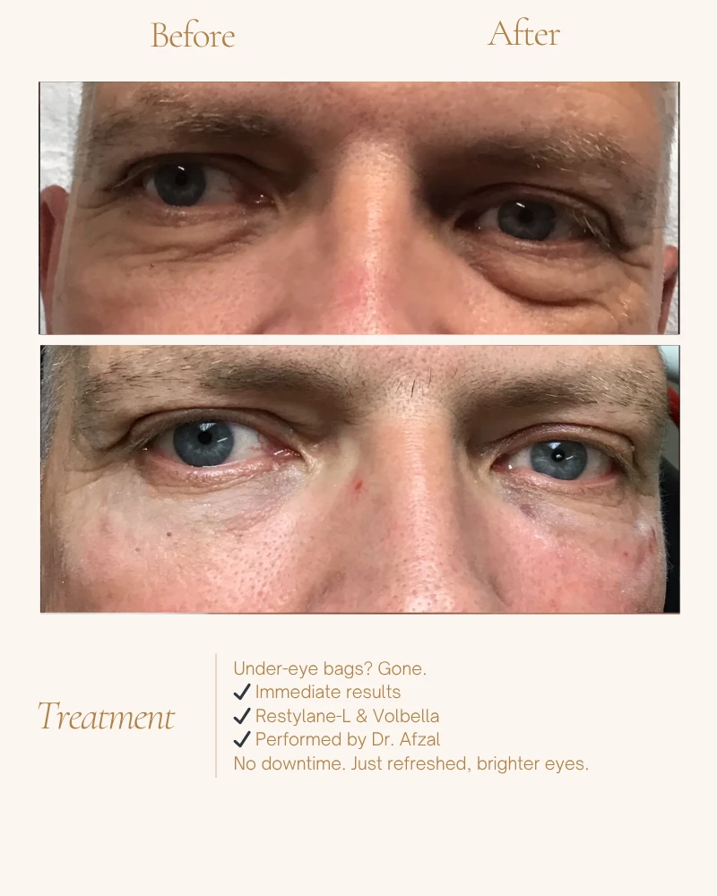 fillers-8