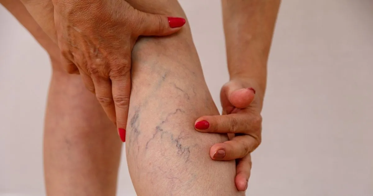 Top Causes of Spider Veins You Should Know