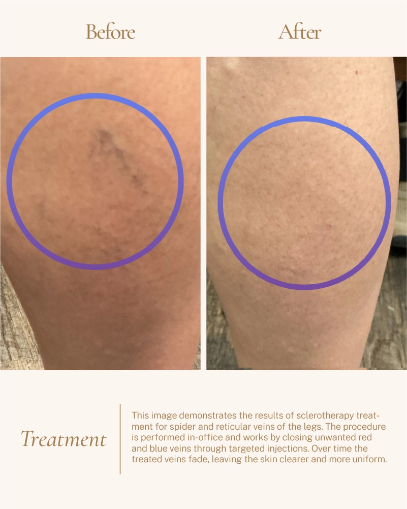 Before and after sclerotherapy treatment reducing spider veins for clearer, smoother leg skin.