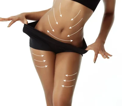 Body Thread Lift by Afzal Clinics in Edina, MN and Fridley, MN